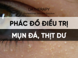 PHÁC ĐỒ ĐIỀU TRỊ MỤN ĐÁ