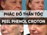 PHÁC ĐỒ PEEL PHENOL