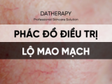 PHÁC ĐỒ ĐIỀU TRỊ LỘ MAO MẠCH MÁU