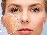 Phương pháp trị sẹo trên mặt hiệu quả